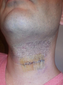 neck surgery